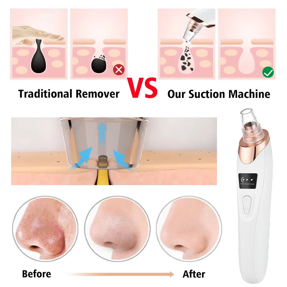 Revolutionary Blackhead Remover Vacuum: Your Ultimate Electric Face Cleaner for Pimple and Acne Removal