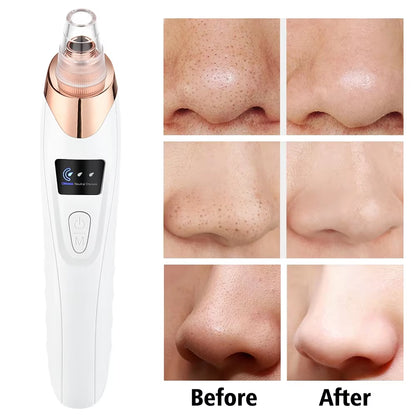 Revolutionary Blackhead Remover Vacuum: Your Ultimate Electric Face Cleaner for Pimple and Acne Removal